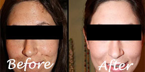 The Esthetic Zone Chemical Peels