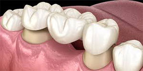 The Esthetic Zone Crown & Bridge