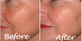The Esthetic Zone Face Anti-aging