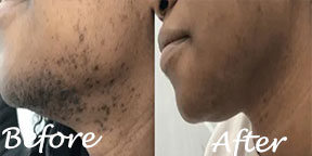 The Esthetic Zone Laser Hair Removal