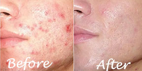 The Esthetic Zone Microdermabrasion