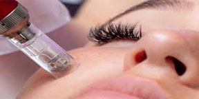 The Esthetic Zone Microneedling