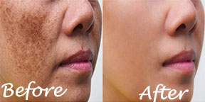 The Esthetic Zone Pigmentation Treatment