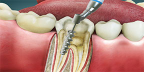 The Esthetic Zone Root Canal