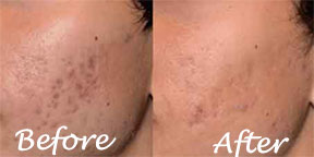 The Esthetic Zone Skin Rejuvenation