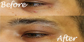 The Esthetic Zone Skin Tag & Wart Removal